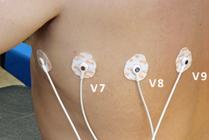 Figura 3: Colocacin electrodos derivaciones izquierdas posteriores