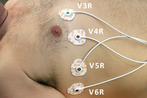 Figura 4: Colocacin electrodos derivaciones derechas